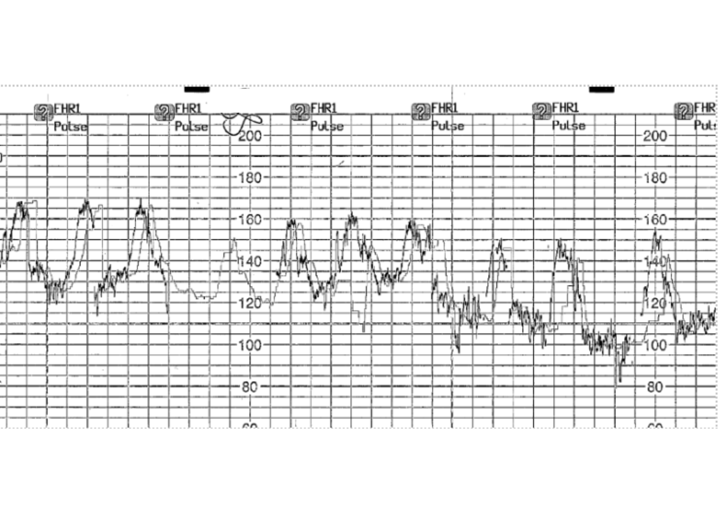 mother’s heart rate as shown CTG trace
